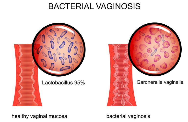 Viêm âm đạo do vi khuẩn