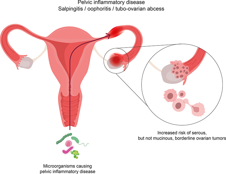 Bệnh viêm vùng chậu (PID)