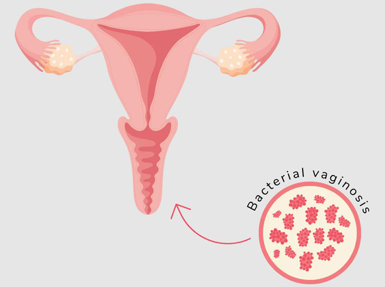 Nhiễm trùng âm đạo không thể tự khỏi mà không cần sử dụng thuốc kháng sinh