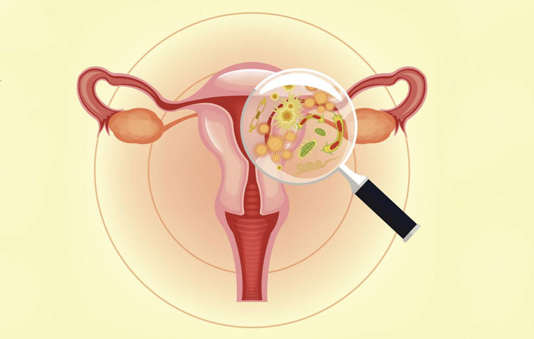 Tại sao bị viêm phụ khoa tái đi tái lại