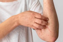 Viêm Da Cơ Địa: Triệu Chứng Và Cách Hỗ Trợ Điều Trị [Chuyên Gia Tư Vấn]