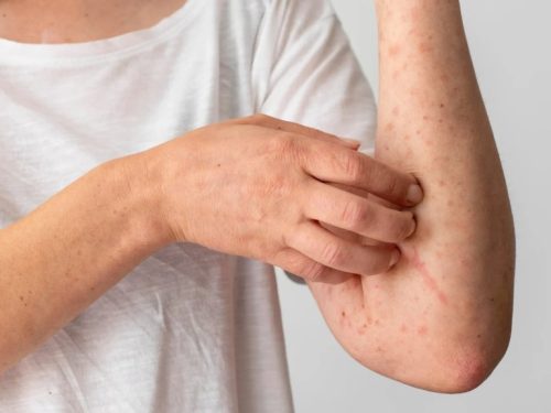 Viêm Da Cơ Địa: Triệu Chứng Và Cách Hỗ Trợ Điều Trị [Chuyên Gia Tư Vấn]