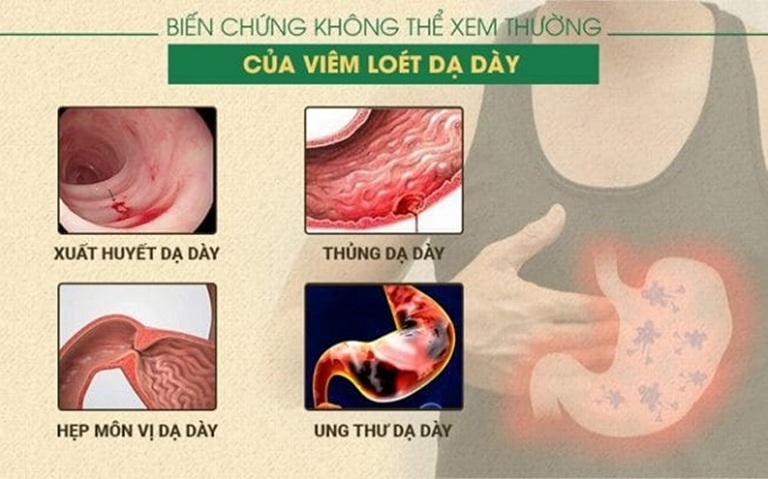 Viêm/ viêm loét dạ dày có thể gây ra nhiều biến chứng nghiêm trọng nếu không xử lý đúng cách, kịp thời Viêm/ viêm loét dạ dày có thể gây ra nhiều biến chứng nghiêm trọng nếu không xử lý đúng cách, kịp thời