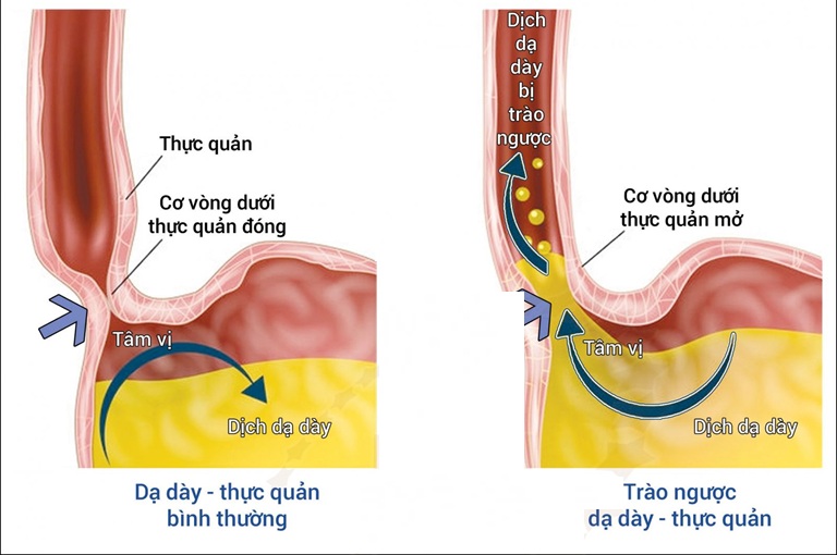 Hiểu hơn về cơ chế gây trào ngược dạ dày qua hình ảnh 